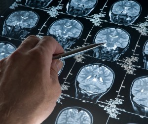 A Radically New Understanding of Alzheimer's Disease Causes and Cures