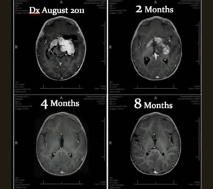 Above: The progression of healing in the 8 month old infant as the tumor (large white center mass in upper left) gradually disappeared in 8 months through treatment with cannabinoids.
