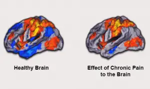 Improving Your Health Through Meditation - Healthy Brain vs. Chronic Pain