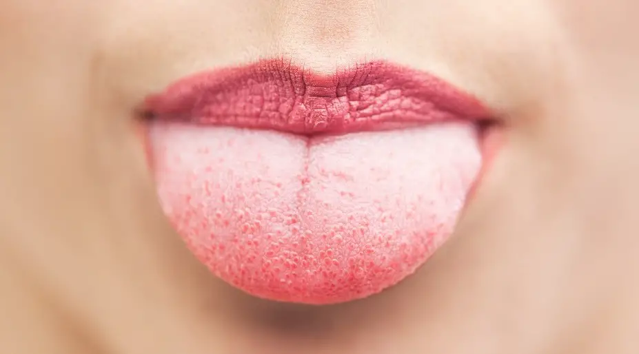 Ayurvedic Tongue Diagnosis Made Easy Wake Up World