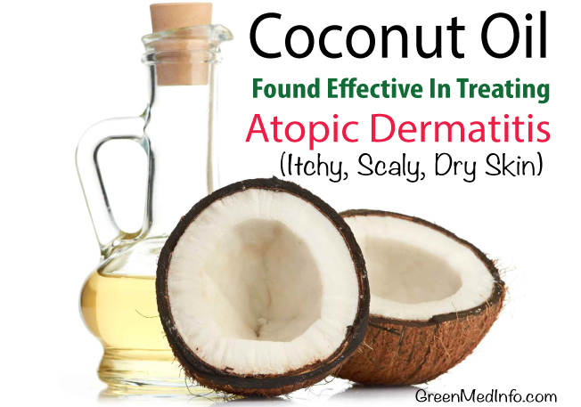 Coconut Oil Found Effective In Treating Atopic Dermatitis (Dry, Itchy, Scaly Skin) - Coconut Oil for Skin