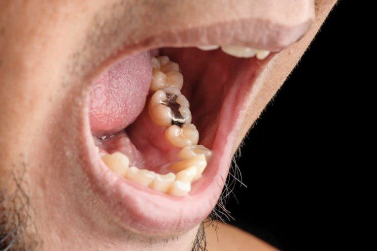 Amalgam Fillings Release Mercury Vapor Into Your Body 24/7