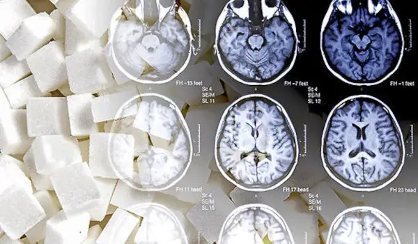 How Sugar Harms Your Brain And Drives Alzheimer’s Epidemic